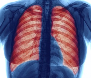 Lung infection